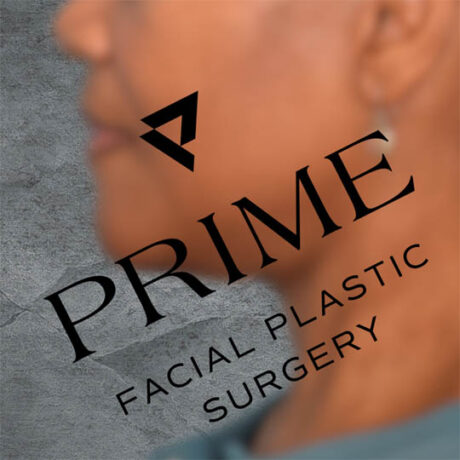 Facelift case #3807