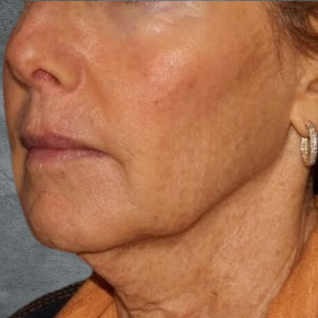 Fillers case #3833