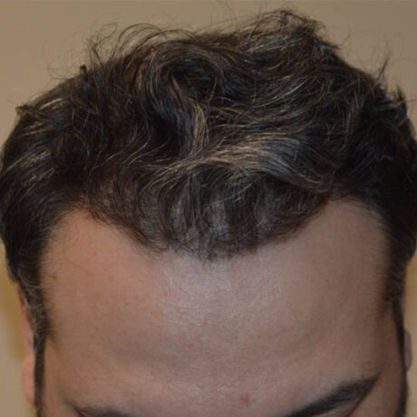 Hair Transplant case #3851