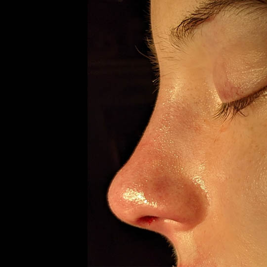 Rhinoplasty case #3915