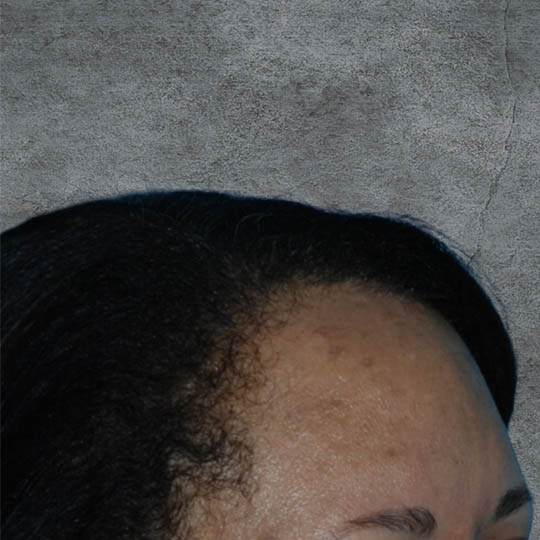 Hair Transplant case #3857