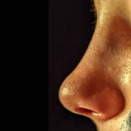 Rhinoplasty case #3909