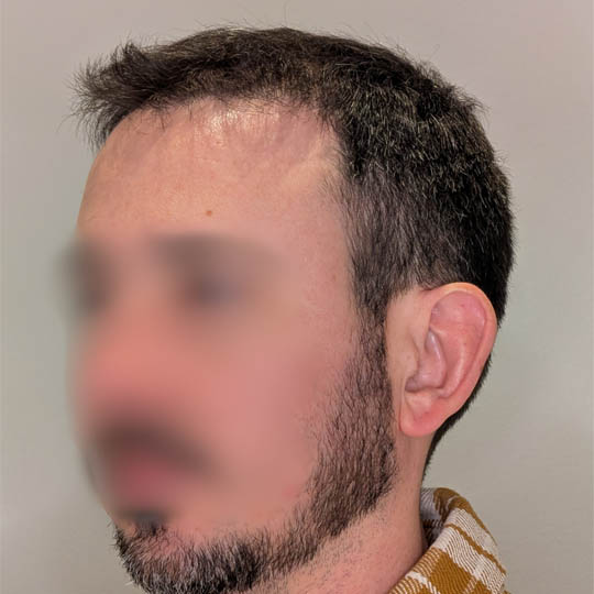 Hair Transplant case #4260