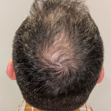 Non-surgical Hair Restoration case #4266