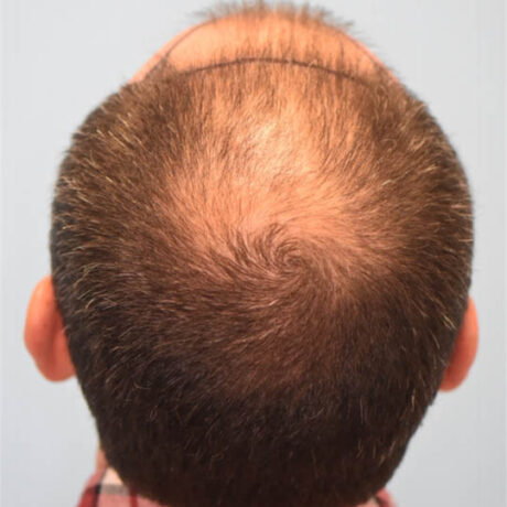 Non-surgical Hair Restoration case #4266