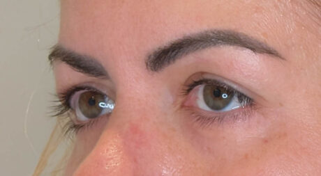 Eyelid Surgery case #4336