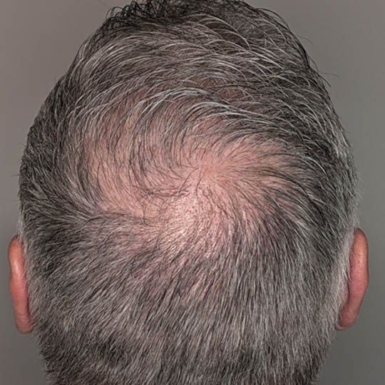 Hair Transplant case #4416