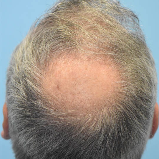 Hair Transplant case #4416