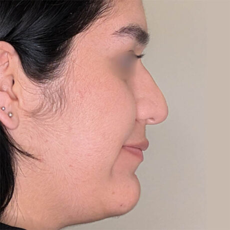 Rhinoplasty case #4475