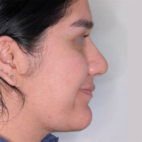 Rhinoplasty case #4475
