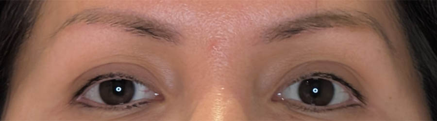 Eyebrow Transplant case #4478