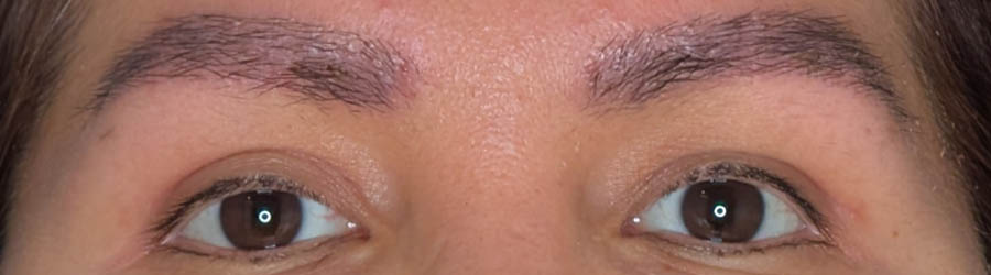 Eyebrow Transplant case #4478