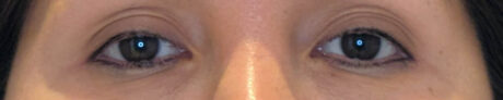 Eyelid Surgery case #4481