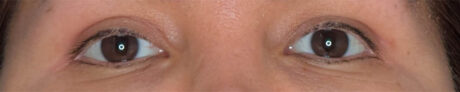 Eyelid Surgery case #4481