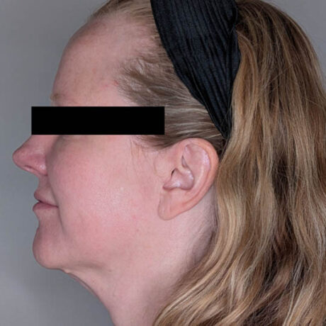 Facelift case #4589