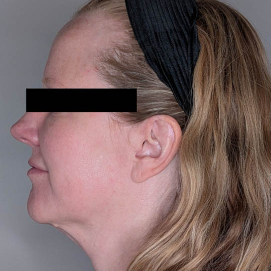 Facelift case #4589
