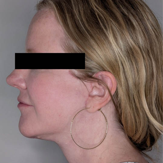 Facelift case #4589