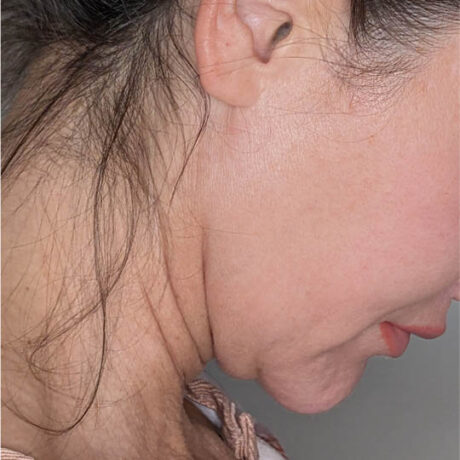 Facelift case #4592