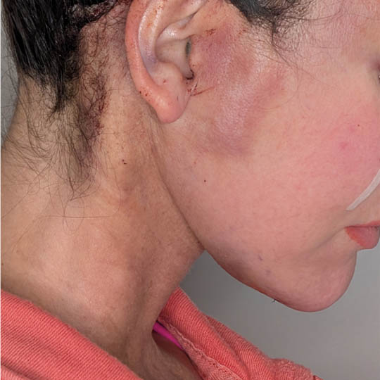 Facelift case #4592