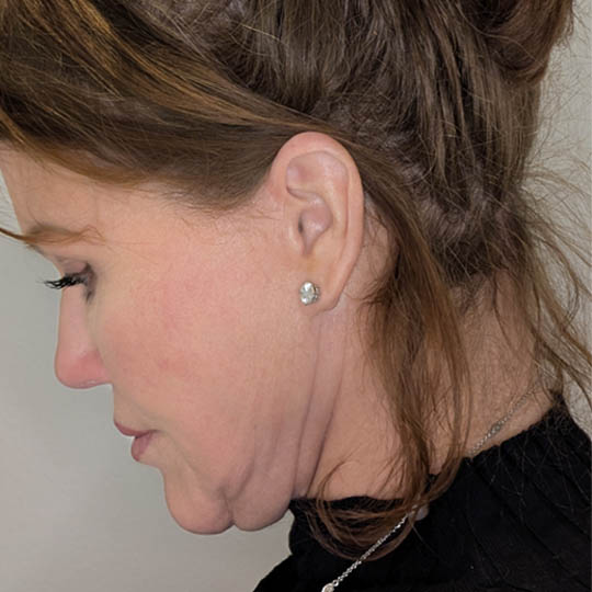 Facelift case #4598