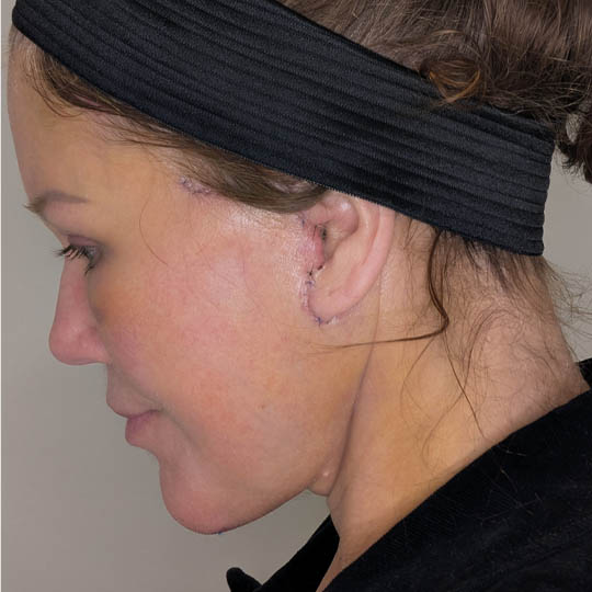 Facelift case #4598