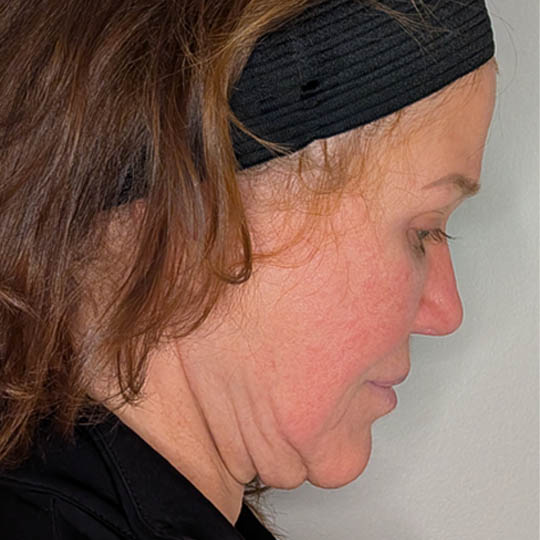 Neck Lift case #4719