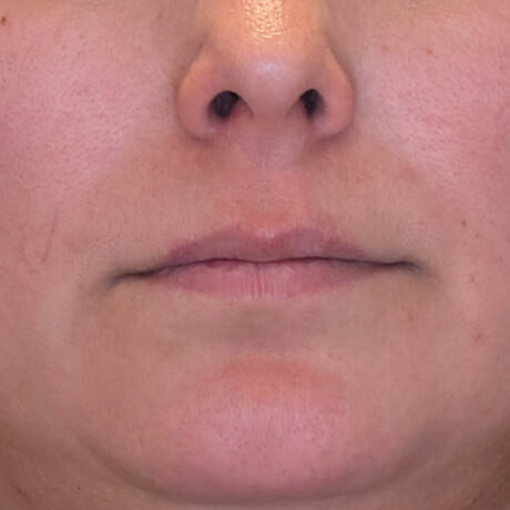 Lip Filler case #4712