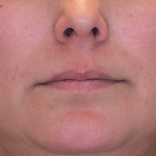 Lip Filler case #4712