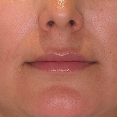 Lip Filler case #4712