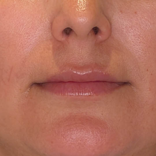 Lip Filler case #4712
