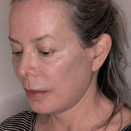 Facelift case #4720