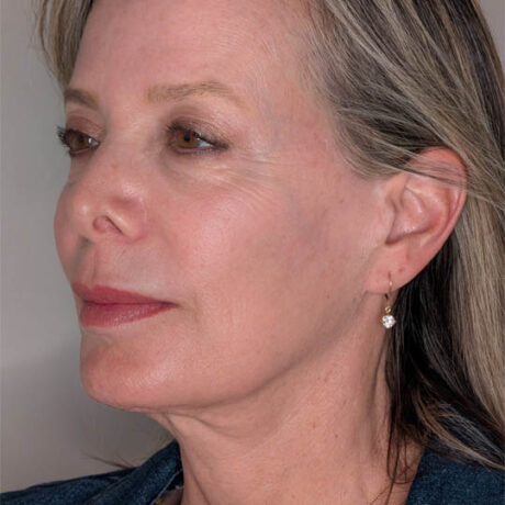 Facelift case #4720