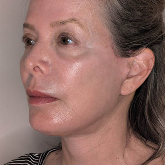 Facelift case #4720