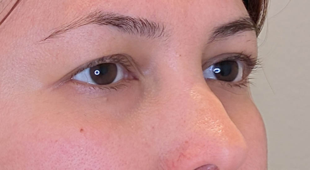 Eyelid Surgery case #4689
