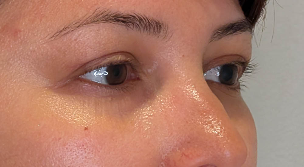 Eyelid Surgery case #4689