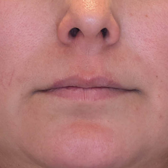 Lip Filler case #4712