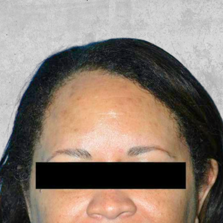 Hairline Lowering case #4679