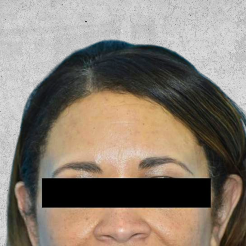 Hairline Lowering case #4679