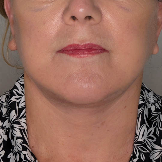 Facelift case #4812