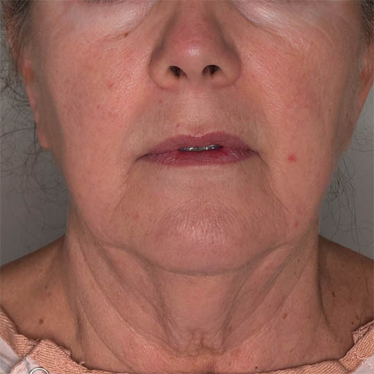Facelift case #4812