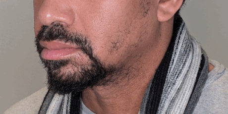 Beard Transplant case #5075