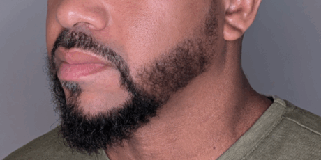 Beard Transplant case #5075