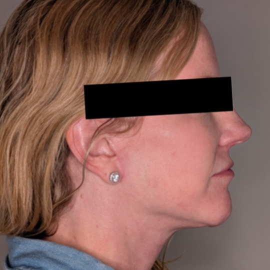 Facelift case #5072