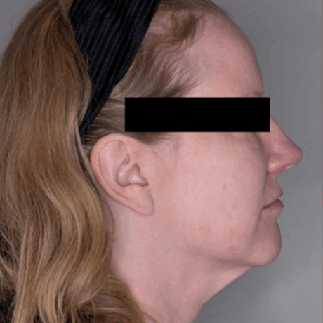 Facelift case #5072