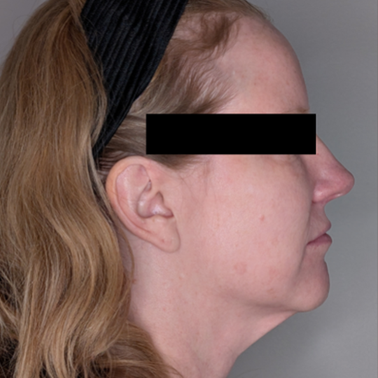 Facelift case #5072