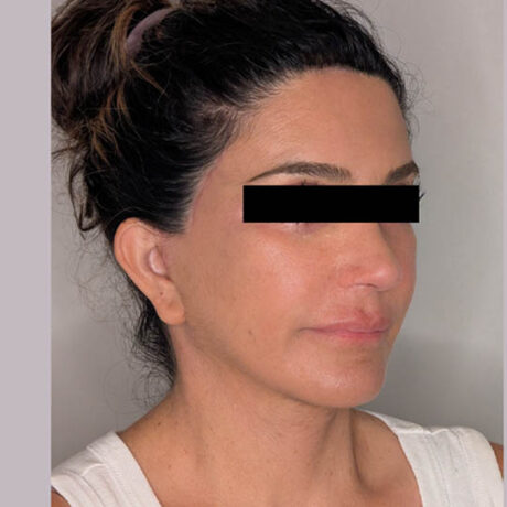 Facelift case #5243