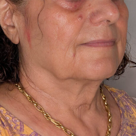 Facelift case #5246