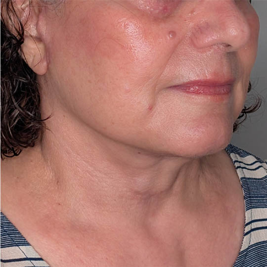 Facelift case #5246