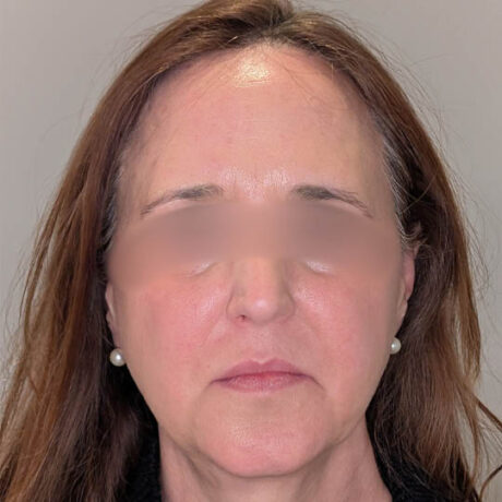 Brow Lift case #5371