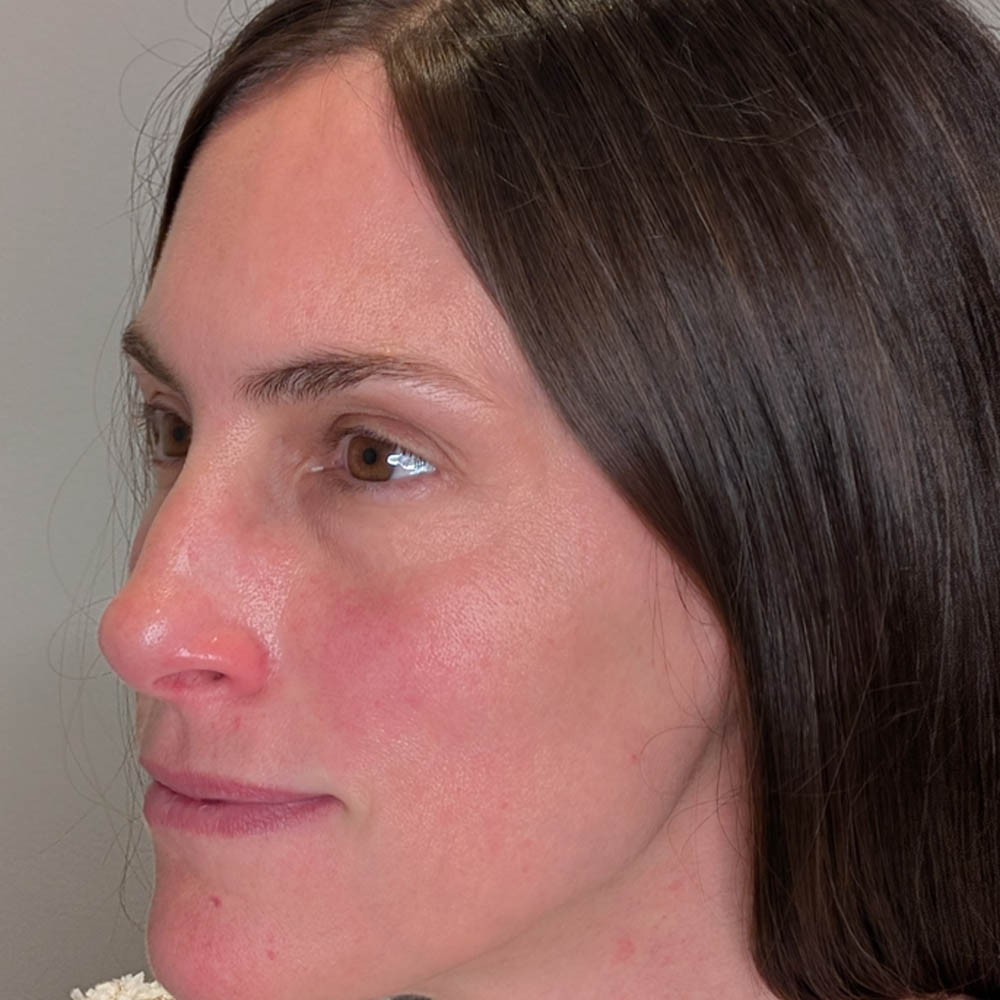 Eyelid Surgery case #5397